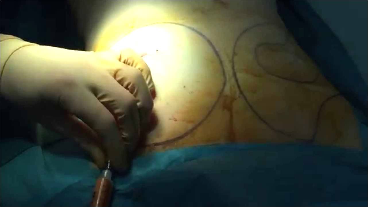 En este momento estás viendo Reconstrucción mamaria puede ser alternativa años después de la mastectomía