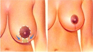 Lee más sobre el artículo Ellas van contra la corriente: muchas mujeres eligen reducir sus senos