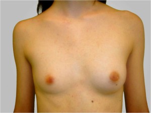 Lee más sobre el artículo Asimetría mamaria: un ‘defecto’ natural generalizado en las mujeres