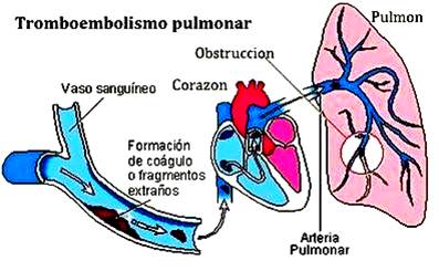 En este momento estás viendo Tromboembolismo pulmonar en cirugía plástica: factores de riesgo, protocolos y recomendaciones