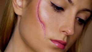 Lee más sobre el artículo ¿Por qué es importante tratar las Cicatrices Inestéticas?