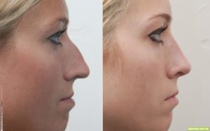Lee más sobre el artículo ¿Qué tipos de nariz aplican para una Rinoplastia?
