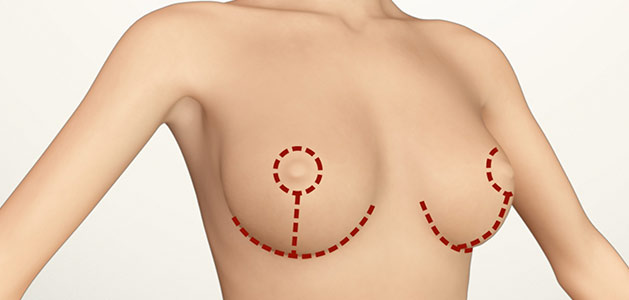 Cirugía del abdomen - Dr. Jorge Peñarrieta
