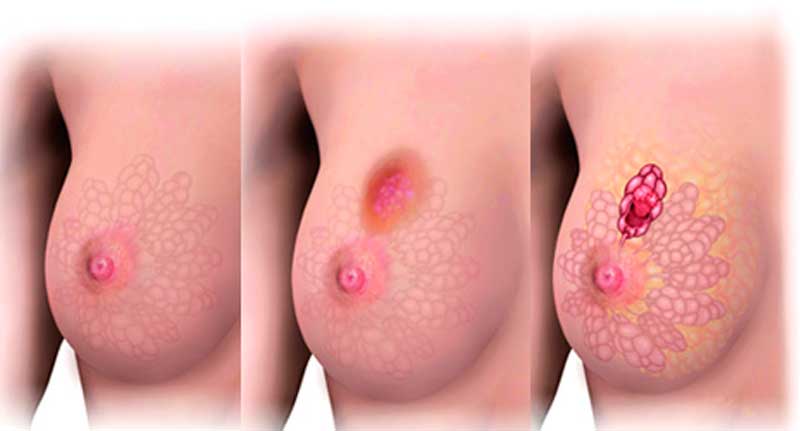 En este momento estás viendo Cáncer de mama: ¿Es posible la prevención?