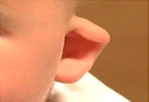 Lee más sobre el artículo Opciones para el tratamiento de orejas con formas anormales en bebés y niños