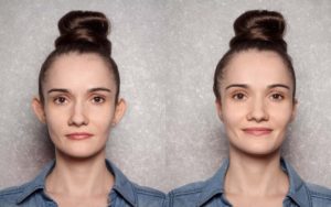 Lee más sobre el artículo Logra la armonía del rostro con otoplastia