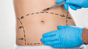Lee más sobre el artículo Cirugía del abdomen